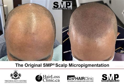 scalp micropigmentation albuquerque|Hair Loss Solution .